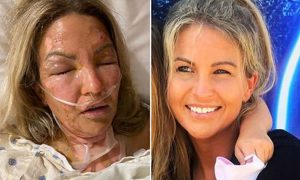 Mulher pega fogo após uso de desinfetante para as mãos contra a Covid-19