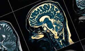 Estudos indicam que coronavírus é capaz de provocar infecção letal no cérebro