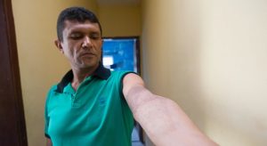 Tratamentos com uso de pele da tilápia aceleram curas e abrem novas possibilidades na área da saúde