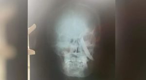 Mulher sobrevive a golpe de faca no crânio no Ceará