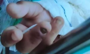 Menina de 2 anos é levada a hospital sem duas unhas e com lesões no intestino