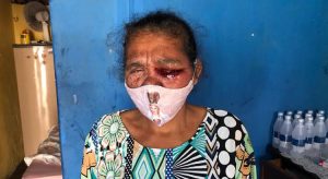 Senhora de Juazeiro do Norte faz apelo para custear tratamento de blefarite crônica