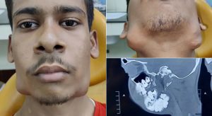 Jovem de 17 anos passa por cirurgia para retirar 82 dentes extras