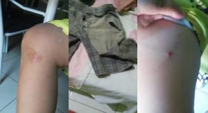 Menino de 7 anos fica ferido após ataque de pitbull em Várzea Alegre