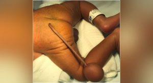 Criança prematura nasce com cauda de 12 centímetros e uma bola na ponta em caso 'raríssimo