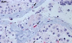 Caso de "flurona" descoberto em Israel não é novidade no Ceará; entenda